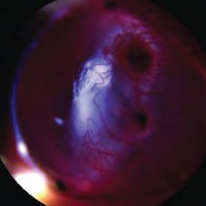 Anterior Brightfield retinal image