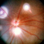 Phoenix MICRON retinal laser image