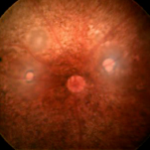 Phoenix MICRON laser retinal image