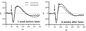 Focal ERG of laser & control eyes