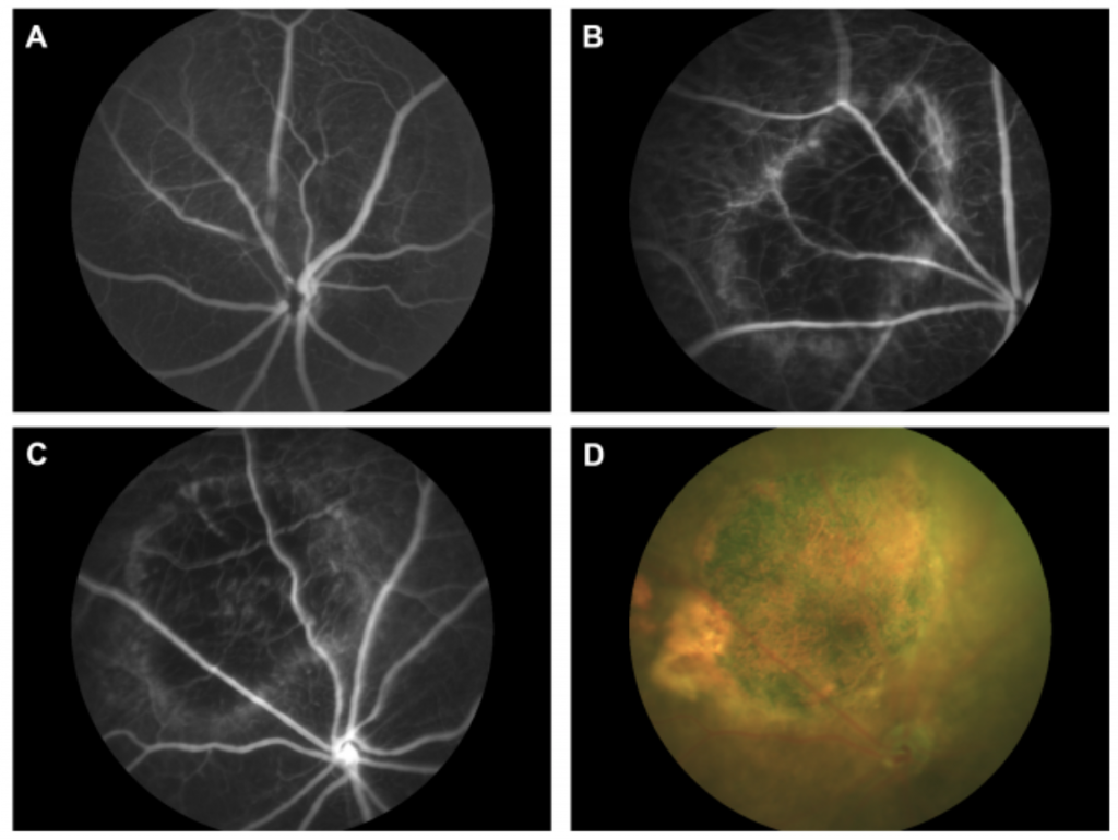 Developing a unique, novel dry AMD model with the Phoenix MICRON® laser ...