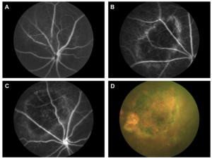 Fluorescein angiography of dry AMD mouse model