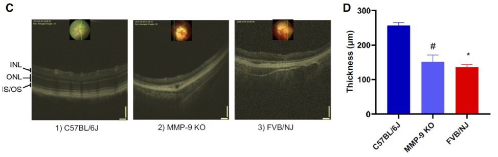 OCT image of thinning of retinal layers seen by Phoenix MICRON<span class=