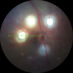 Anterior Bright Field