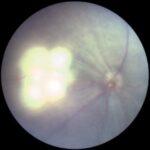 Immediately post 810 nm laser